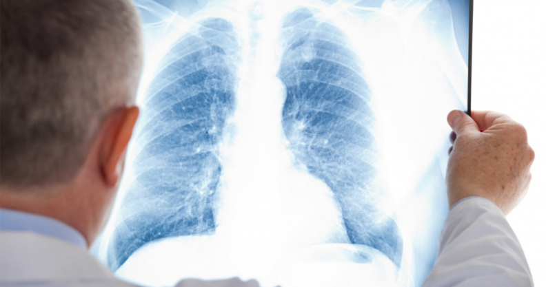 [AKTUALIZACJA] Chorzy na raka płuc bez opieki na Mazowszu Kliknięcie w obrazek spowoduje wyświetlenie jego powiększenia